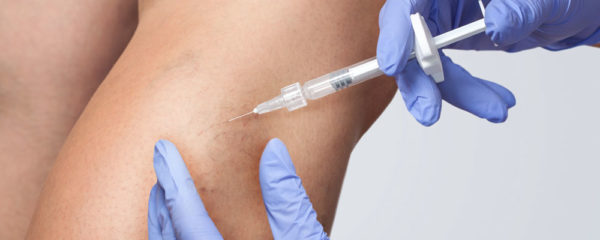Traiter les varices